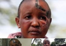 Amputée des deux bras par son mari qui l’accusait d’être stérile. Jackline Mwende est enceinte d’un autre.