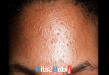 « Quand je couche avec une femme, des boutons apparaissent sur son visage…Que faire? »